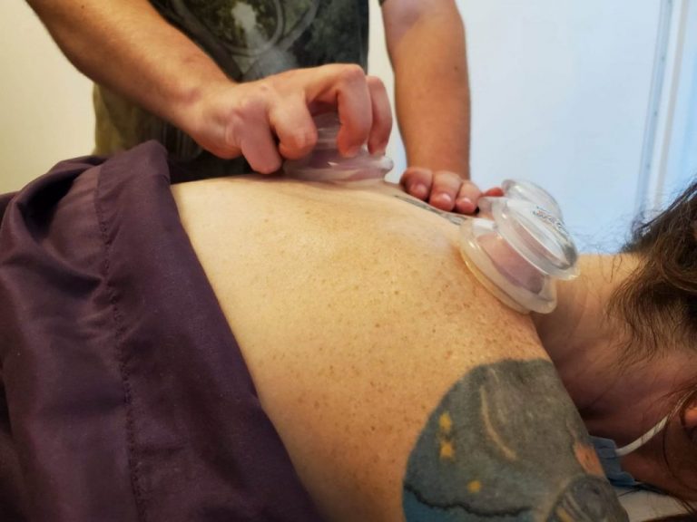 Cupping Therapy FAQs
