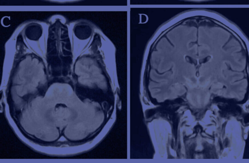 Four mri images highlighting clinical presentations of Lyme neuroborreliosis in a patient's brain.